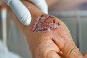 Vancouver Dog Bite Lawyer